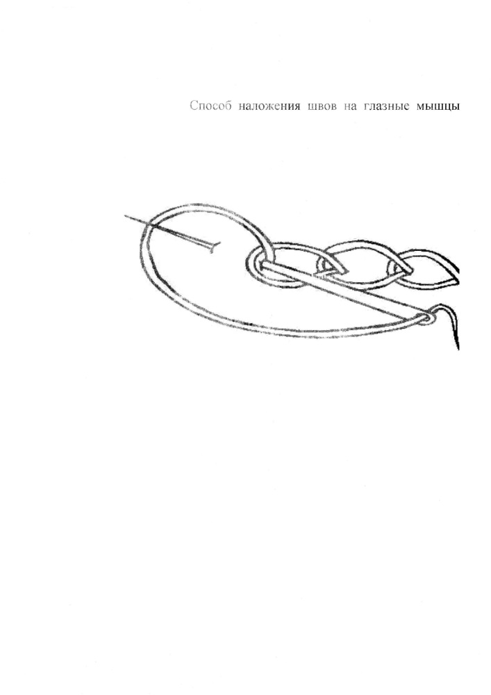 Способ наложения швов на глазные мышцы (патент 2626142)