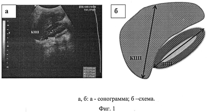 Способ ультразвуковой диагностики воспалительных изменений печени и селезенки при туберкулезе у детей (патент 2535613)