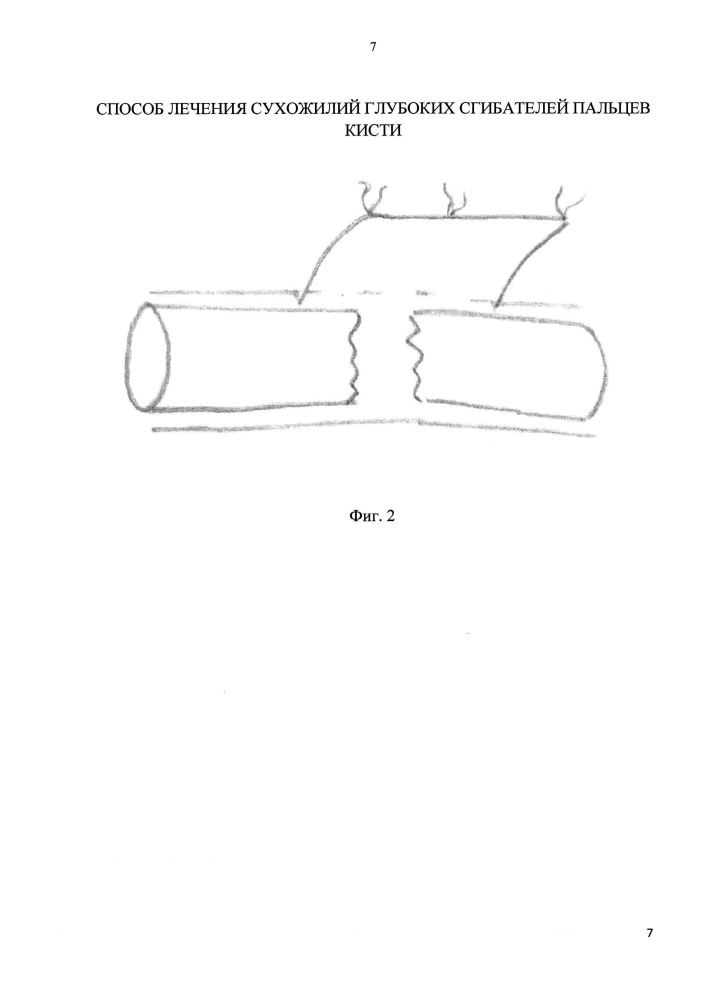 Способ лечения повреждений сухожилий глубоких сгибателей пальцев кисти (патент 2602796)