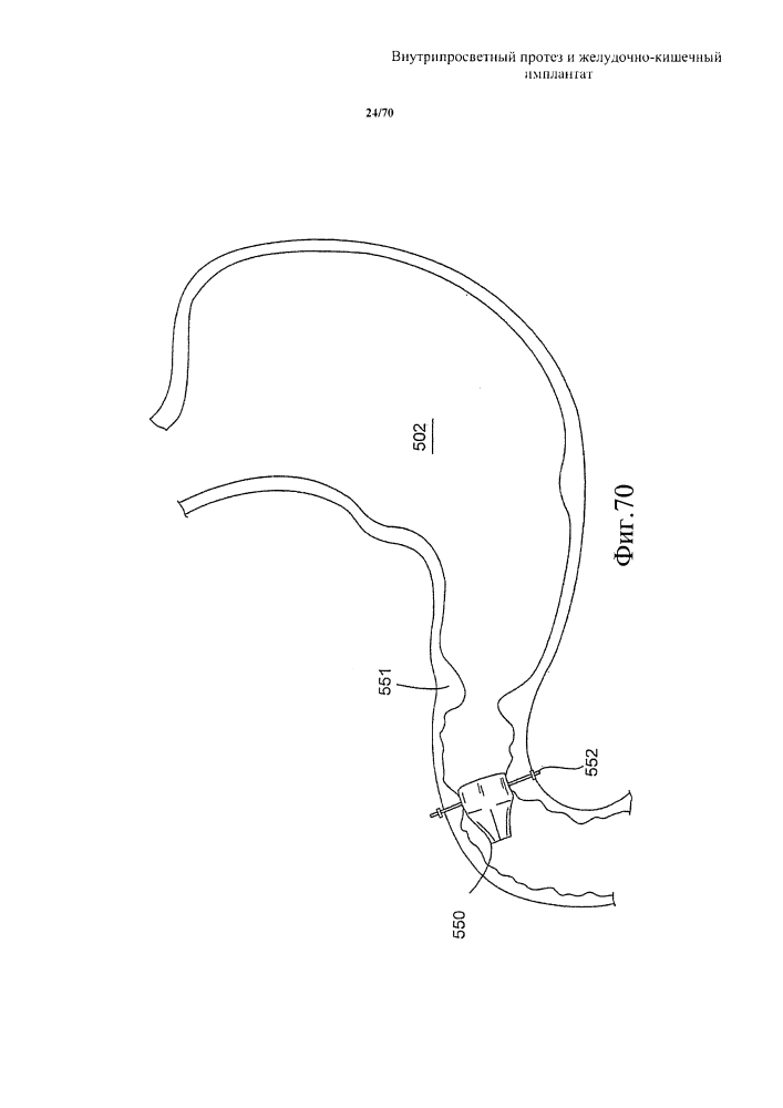 Внутрипросветный протез и желудочно-кишечный имплантат (патент 2626885)