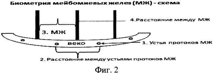 Способ оценки морфофункционального состояния мейбомиевых желез - биометрия мейбомиевых желез (патент 2567829)