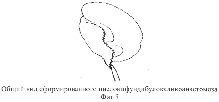 Способ лечения гидронефроза у детей (патент 2495630)