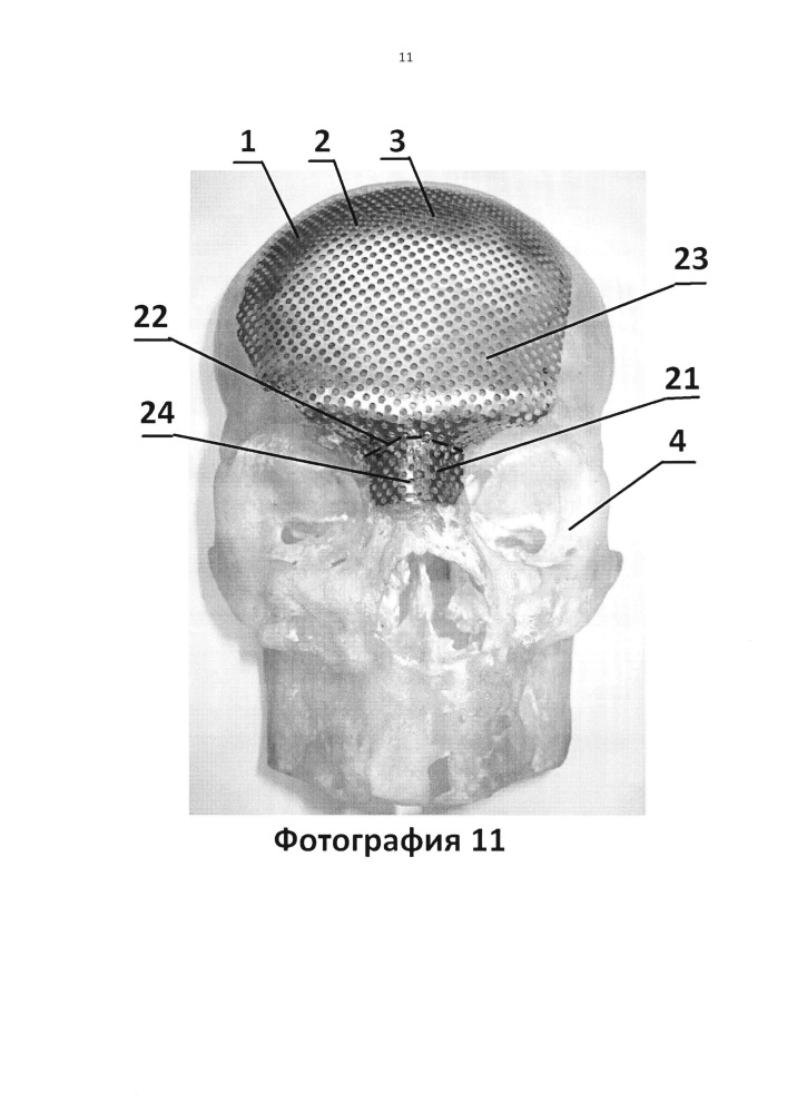 Имплантат для протезирования костей черепа и способ изготовления имплантата для протезирования костей черепа (патент 2638894)
