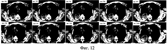 Способ оценки внутренней структуры шаровидных образований легких (патент 2515508)