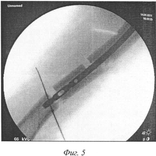 Способ репозиции фрагментарных переломов бедренной кости (патент 2562678)