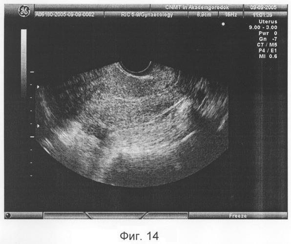 Способ диагностики изменений миометрия (патент 2307590)