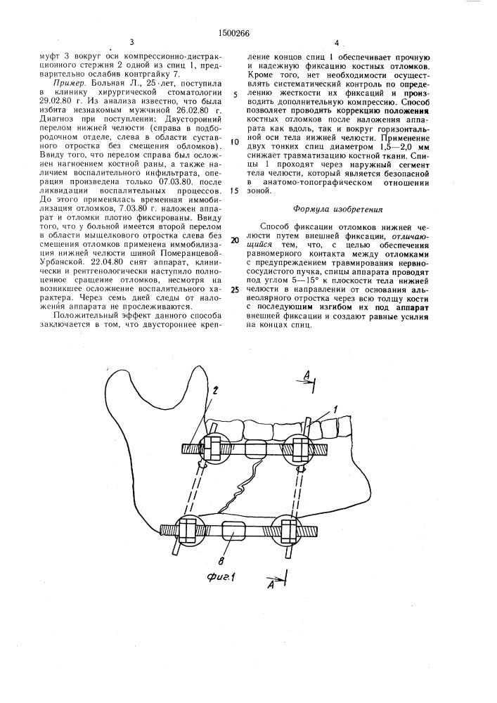 Способ фиксации отломков нижней челюсти (патент 1500266)