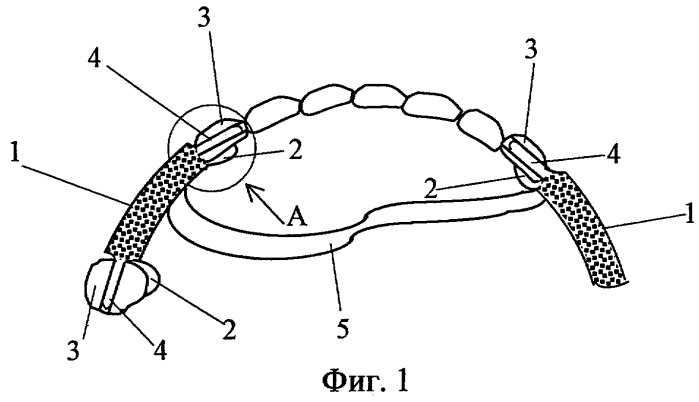 Устройство для крепления бюгельного протеза (патент 2251993)