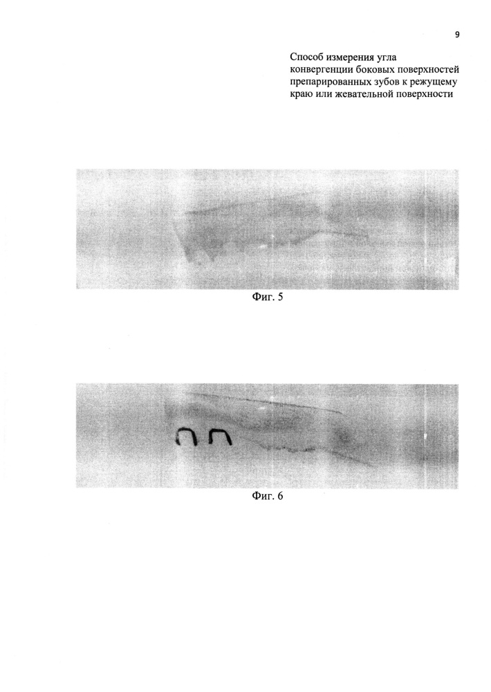 Способ измерения угла конвергенции боковых поверхностей препарированных зубов к режущему краю или жевательной поверхности (патент 2613433)