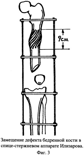 Способ хирургической коррекции дефектов дистальных отделов бедренной кости (патент 2356505)