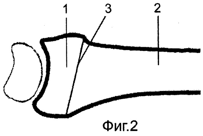 Способ устранения угловой деформации суставного отдела кости (патент 2325862)
