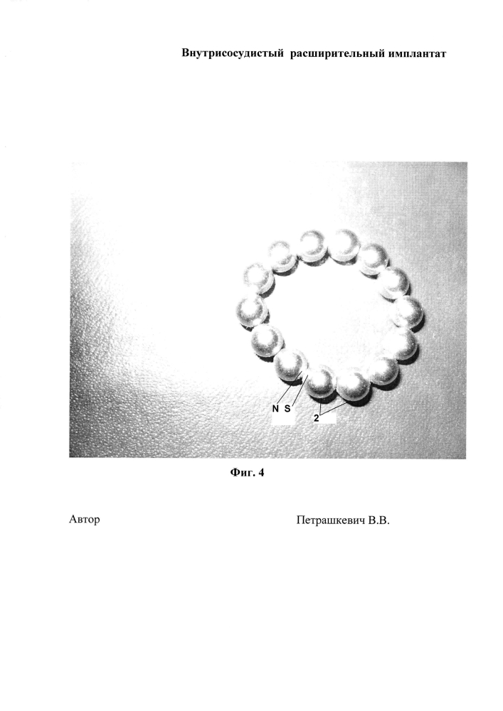 Внутрисосудистый расширительный имплантат (патент 2597408)