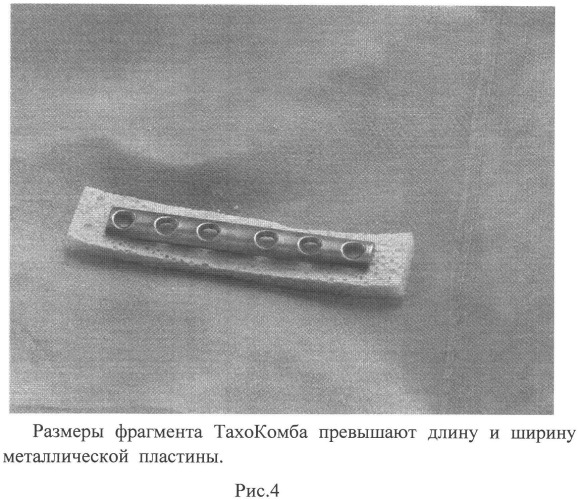 Способ лечения переломов при накостном остеосинтезе (патент 2526472)