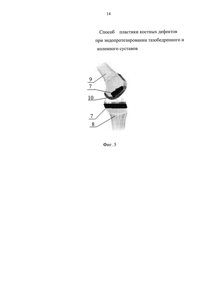 Способ пластики костных дефектов при эндопротезировании тазобедренного и коленного суставов (патент 2622608)