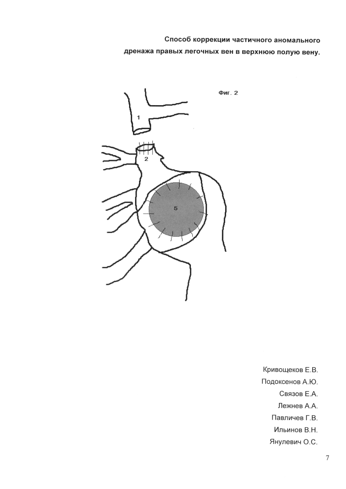 Способ коррекции частичного аномального дренажа правых легочных вен в верхнюю полую вену (патент 2604716)