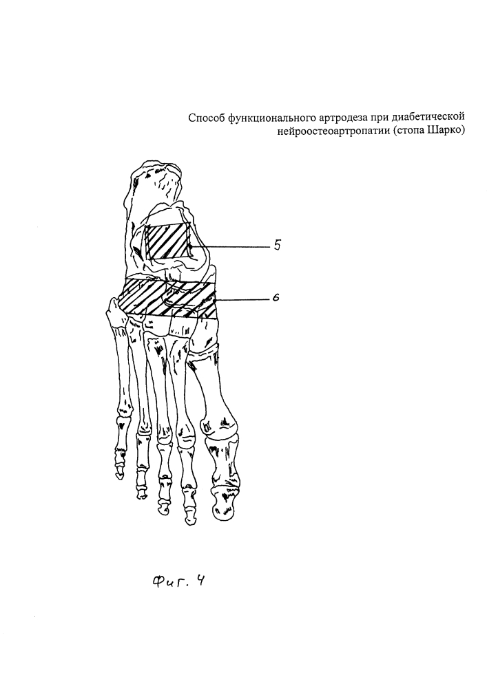 Способ функционального артродеза при диабетической нейроостеоартропатии (стопа шарко) (патент 2604383)