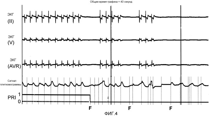 Контроль экг с пониженными ложными тревогами в связи с асистолией (патент 2538623)