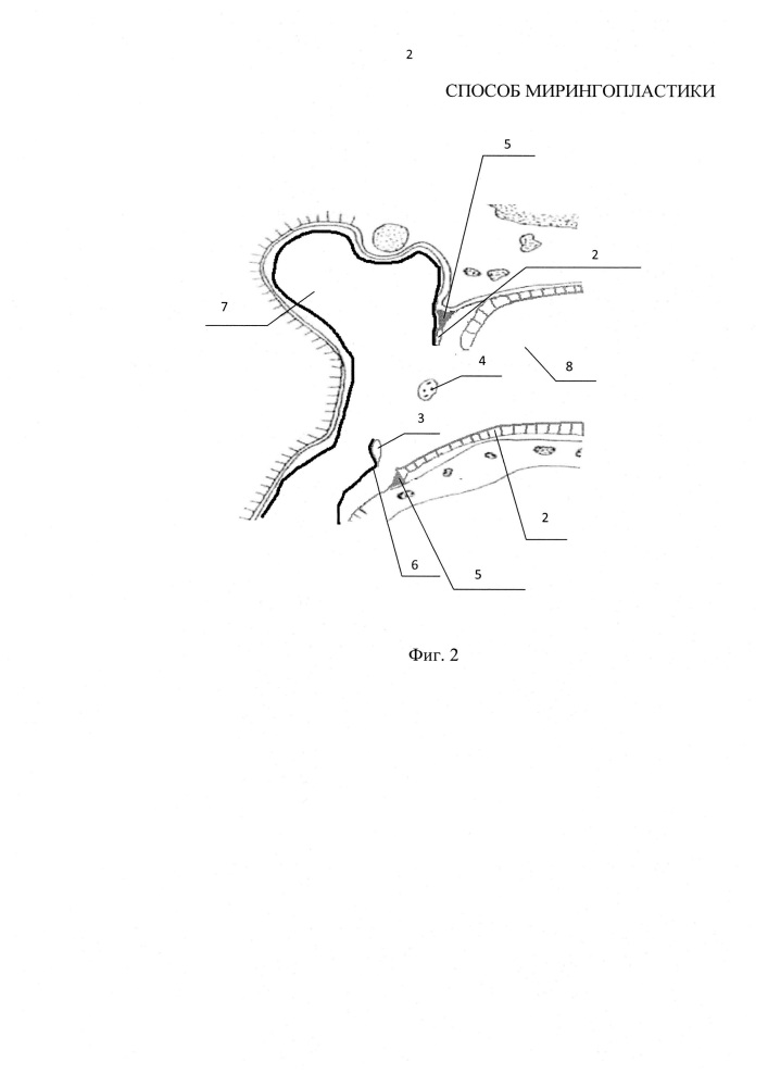 Способ мирингопластики (патент 2649303)