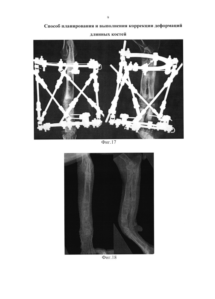 Способ планирования и выполнения коррекции деформаций длинных костей (патент 2641840)