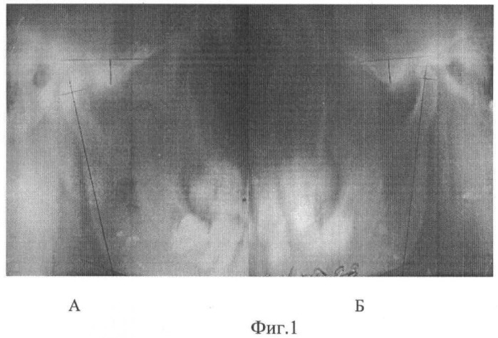 Способ рентгенодиагностики различных типов дисплазии височно-нижнечелюстного сустава (патент 2462993)