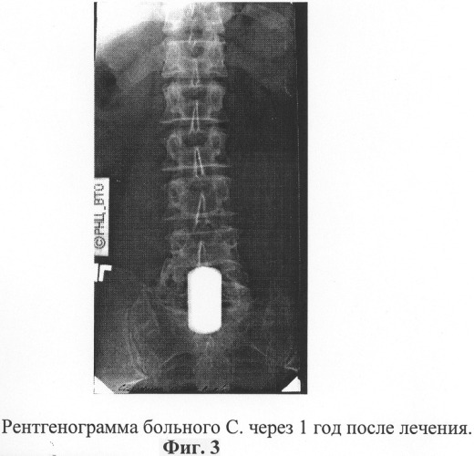 Способ хирургического лечения опухолей позвоночника (патент 2279860)