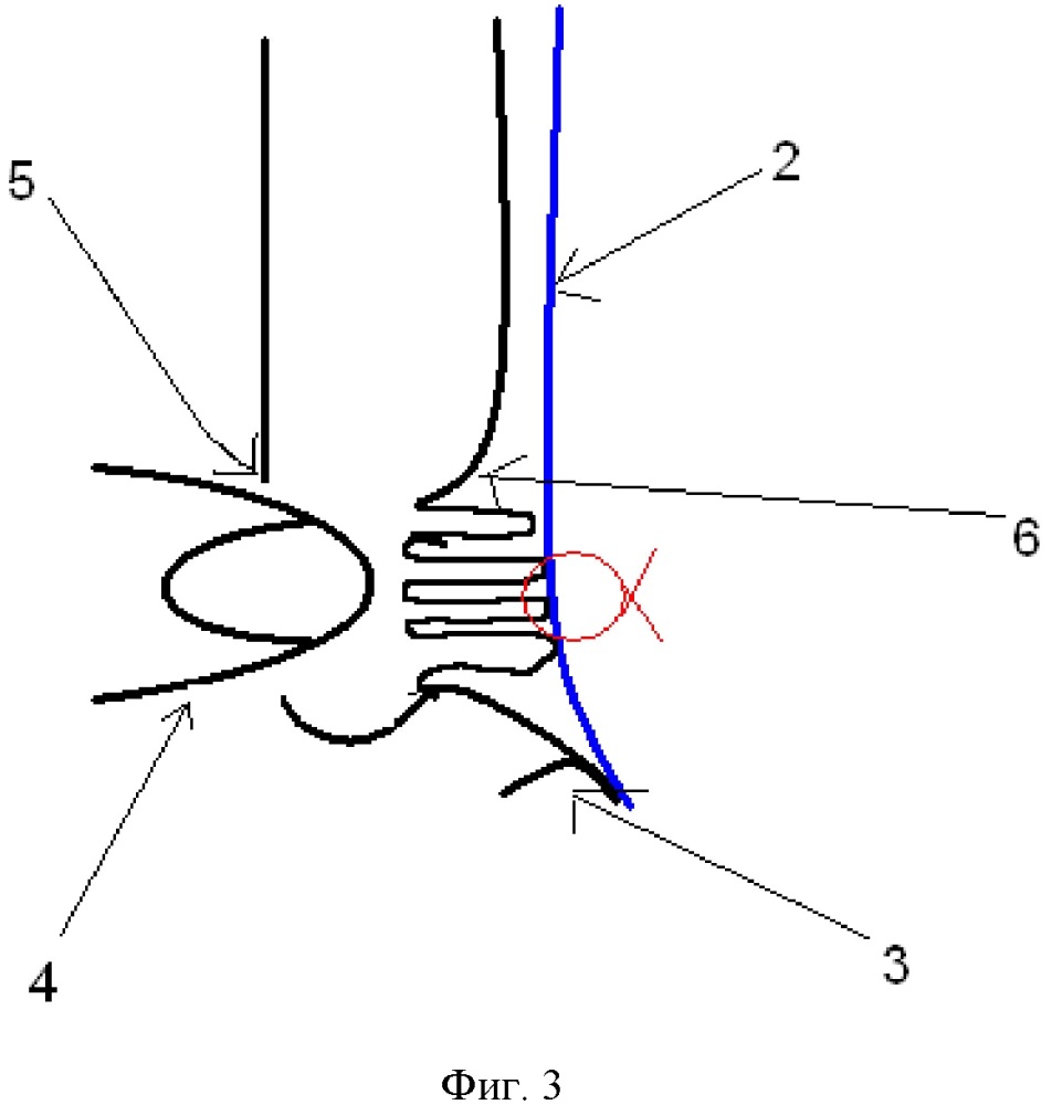 Способ профилактики серомы при лапароскопической паховой герниопластике прямой паховой грыжи (патент 2625445)