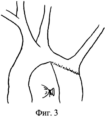 Способ хирургической коррекции коарктации аорты у детей раннего возраста (патент 2477082)