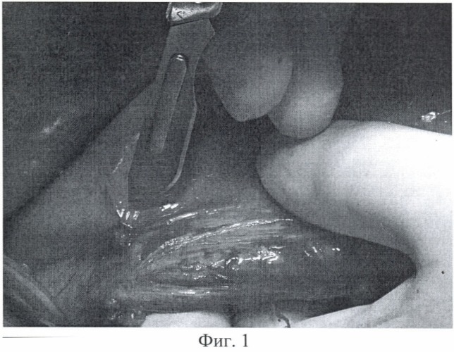 Способ восстановления замыкательного механизма кардии при дистальной резекции желудка (патент 2402285)