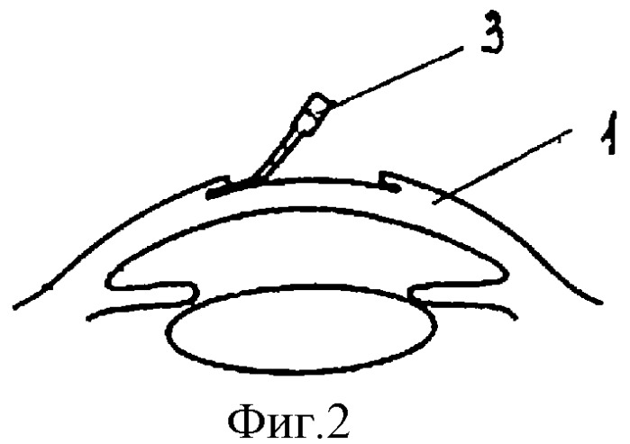 Метод фиксации аллопланта к роговице (патент 2308914)