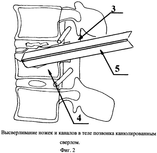 Способ переднего транспедикулярного спондилодеза (патент 2331378)