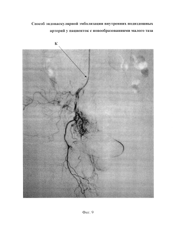 Способ эндоваскулярной эмболизации внутренних подвздошных артерий у пациенток с новообразованиями малого таза (патент 2576092)