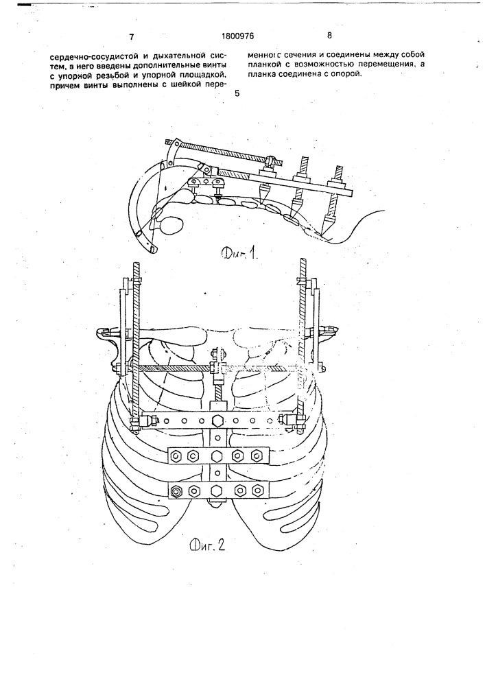 Способ лечения воронкообразной деформации грудной клетки и устройство для его осуществления (патент 1800976)