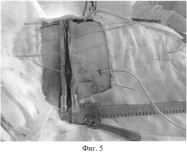 Устройство для закрытия раны после радикальной мастэктомии (патент 2547695)