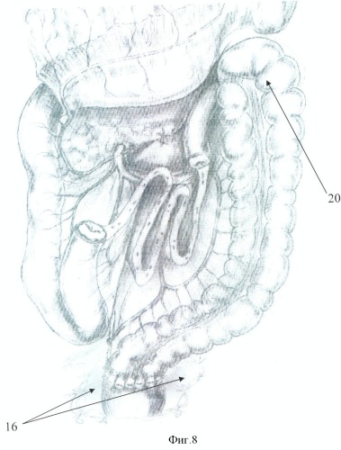 Способ хирургического лечения хронического колостаза, сочетанного с хронической дуоденальной непроходимостью, спланхноптозом и грыжей пищеводного отверстия диафрагмы (патент 2346656)