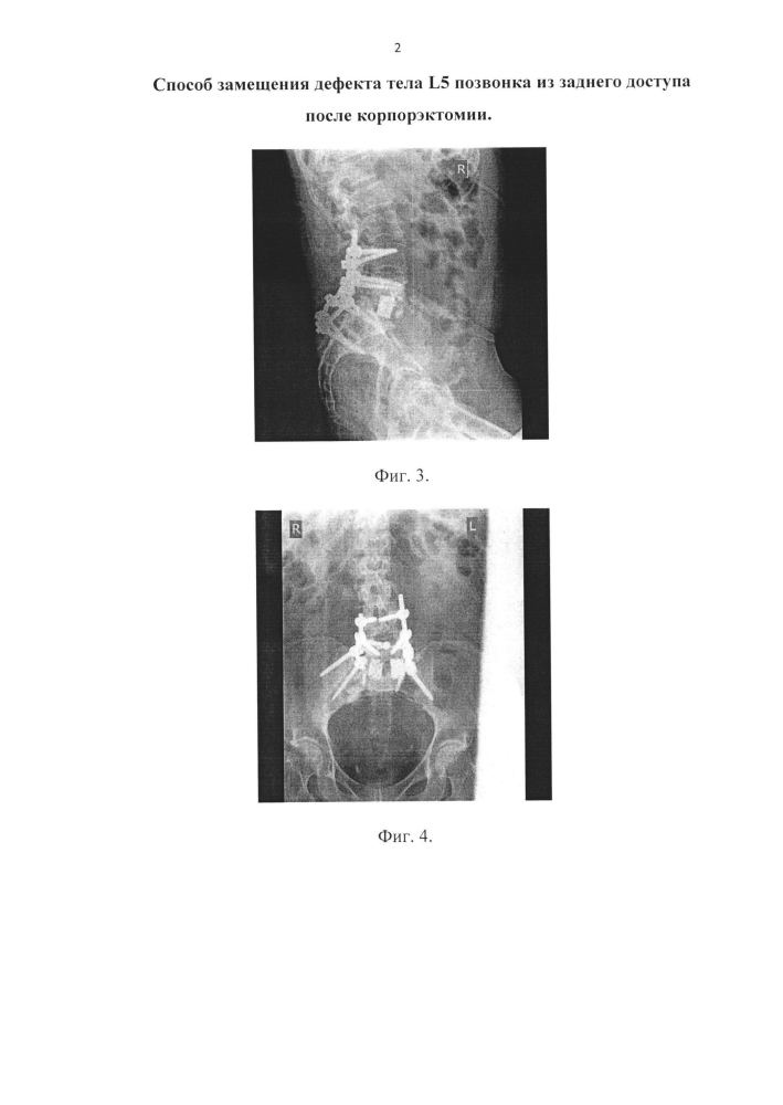 Способ замещения дефекта тела l5 позвонка из заднего оперативного доступа после корпорэктомии (патент 2594445)