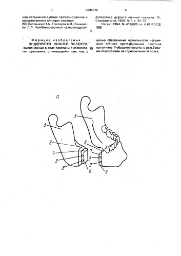 Эндопротез нижней челюсти (патент 2004216)