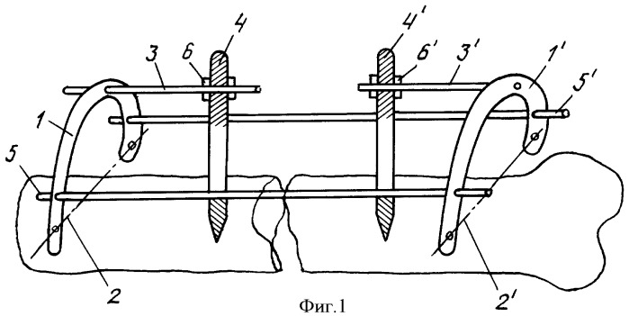 Спице-стержневой аппарат для лечения переломов (патент 2422111)