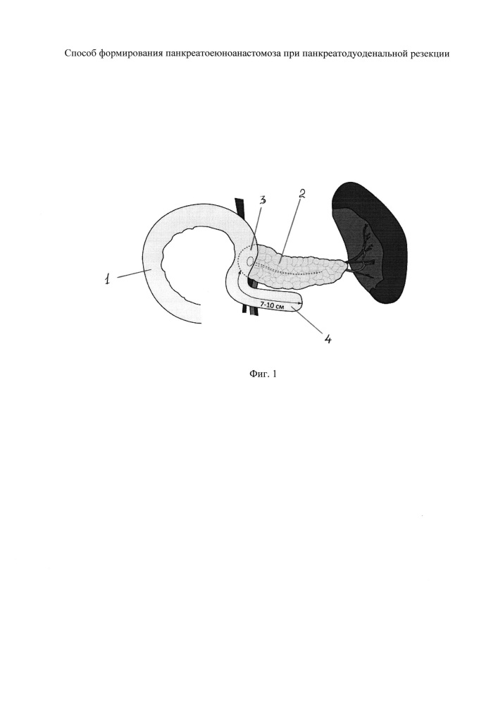 Способ формирования панкреатоеюноанастомоза при панкреатодуодеенальной резекции (патент 2626683)