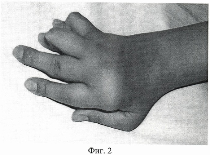Способ устранения ульнарной девиации трехфаланговых пальцев кисти при ревматоидном артрите (патент 2447852)