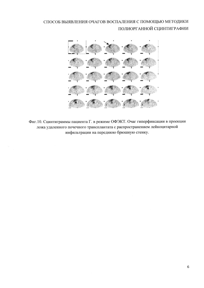 Способ выявления очагов воспаления с помощью методики полиорганной сцинтиграфии (патент 2648877)
