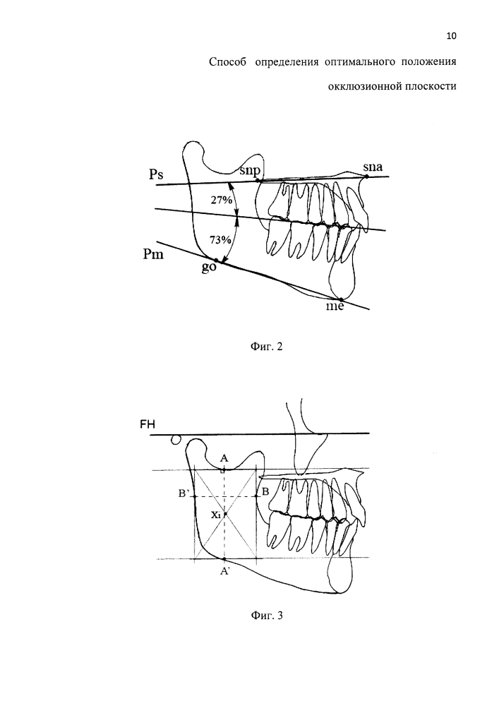 Способ определения оптимального положения окклюзионной плоскости (патент 2610531)