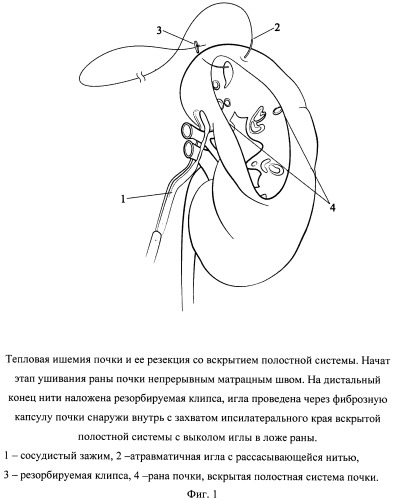 Способ одномоментного закрытия раны и полостной системы почки при лапароскопической резекции (патент 2532942)