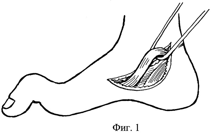 Способ хирургического лечения молоткообразной деформации первого пальца стопы (патент 2285477)