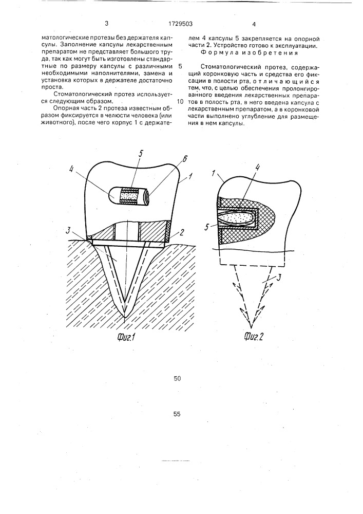 Стоматологический протез (патент 1729503)