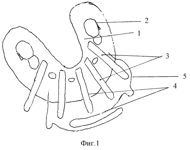 Шина для лечения переломов альвеолярного отростка верхней челюсти (патент 2290146)