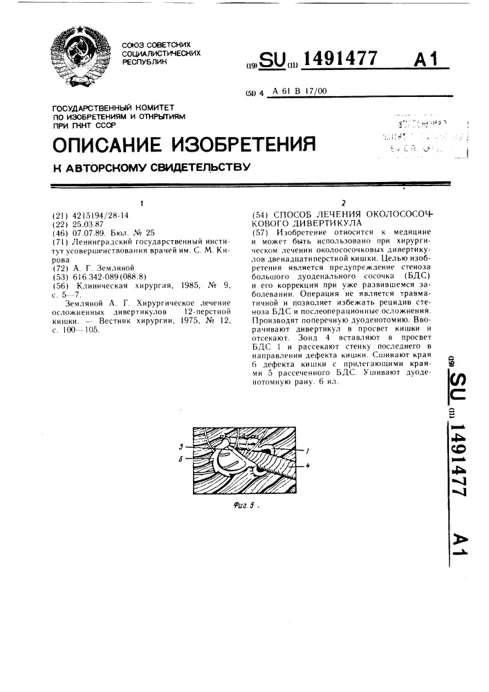 Способ лечения околососочкового дивертикула (патент 1491477)