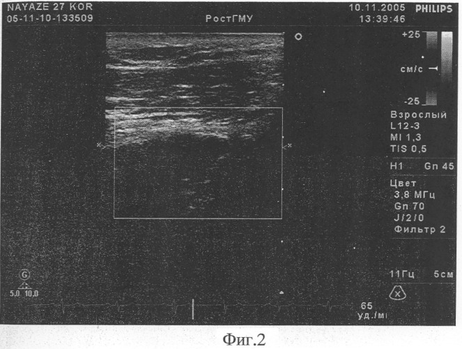 Способ оценки коронарного резерва миокарда левого желудочка (патент 2326598)