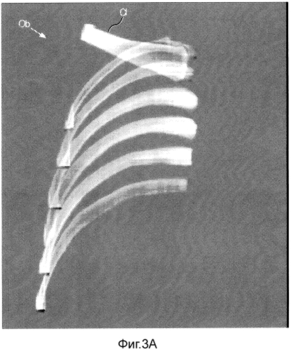 Ослабление костей на рентгенологических снимках (патент 2556428)