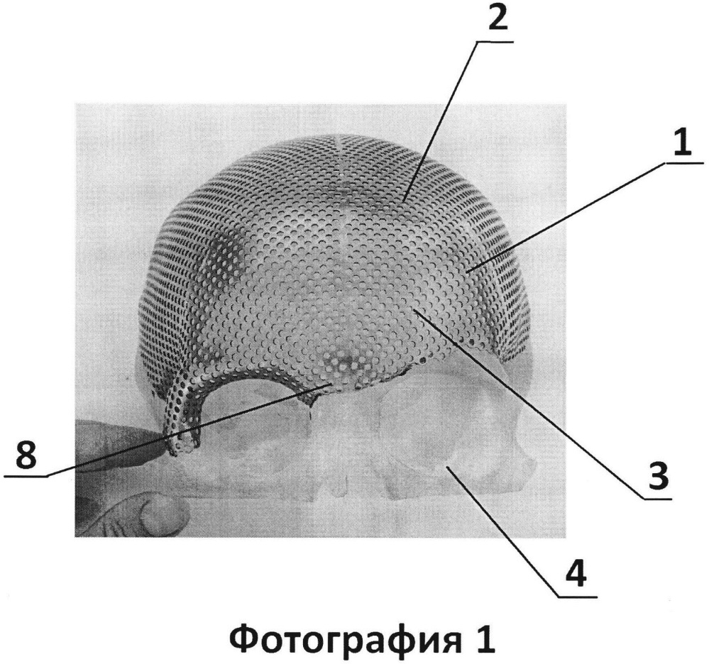 Имплантат для протезирования костей черепа и способ изготовления имплантата для протезирования костей черепа (патент 2638894)
