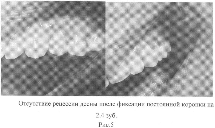 Способ восстановления дефектов зубов (патент 2460490)